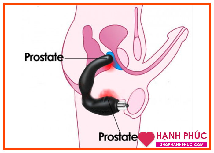 Đồ chơi tình dục cho nam nữ – dụng cụ điều trị tuyết tiền liệt